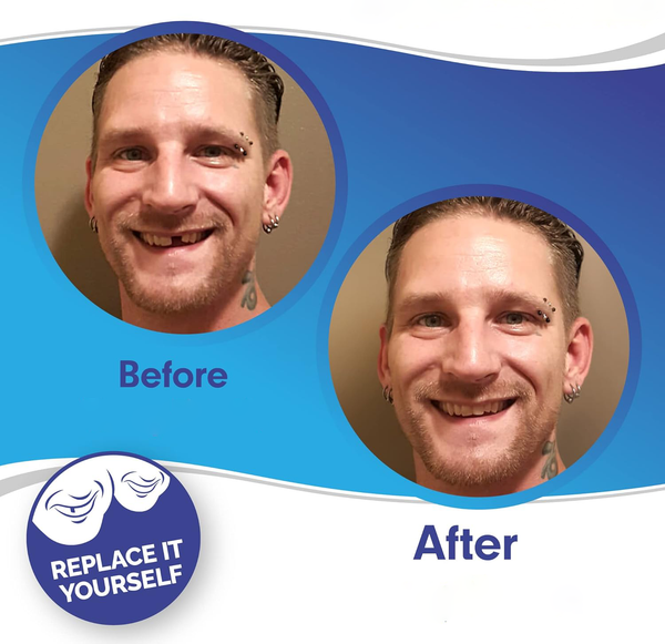 Smile Veneer Set - Complete Upper & Lower Teeth Coverage for a Perfect Smile