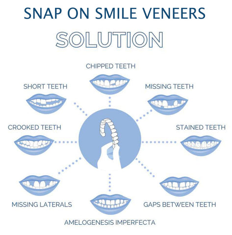 Smile Veneer Set - Complete Upper & Lower Teeth Coverage for a Perfect Smile