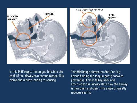 Tongue Stabilizing Device for Sleep Apnea Relief | Comfortable & Effective Solution