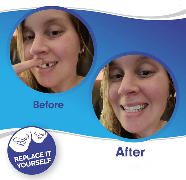 Smile Veneers Set - Premium Upper & Lower Cosmetic Dental Veneers for a Perfect Smile