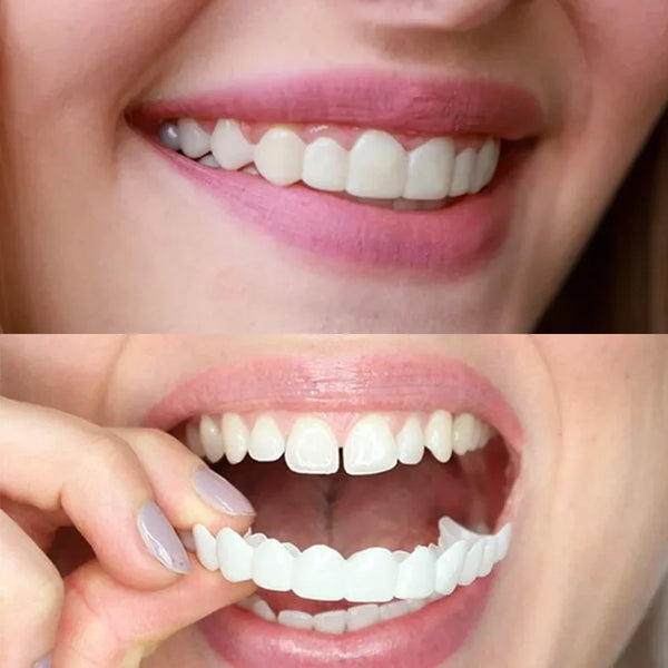 Smile Veneers Set - Premium Upper & Lower Cosmetic Dental Veneers for a Perfect Smile