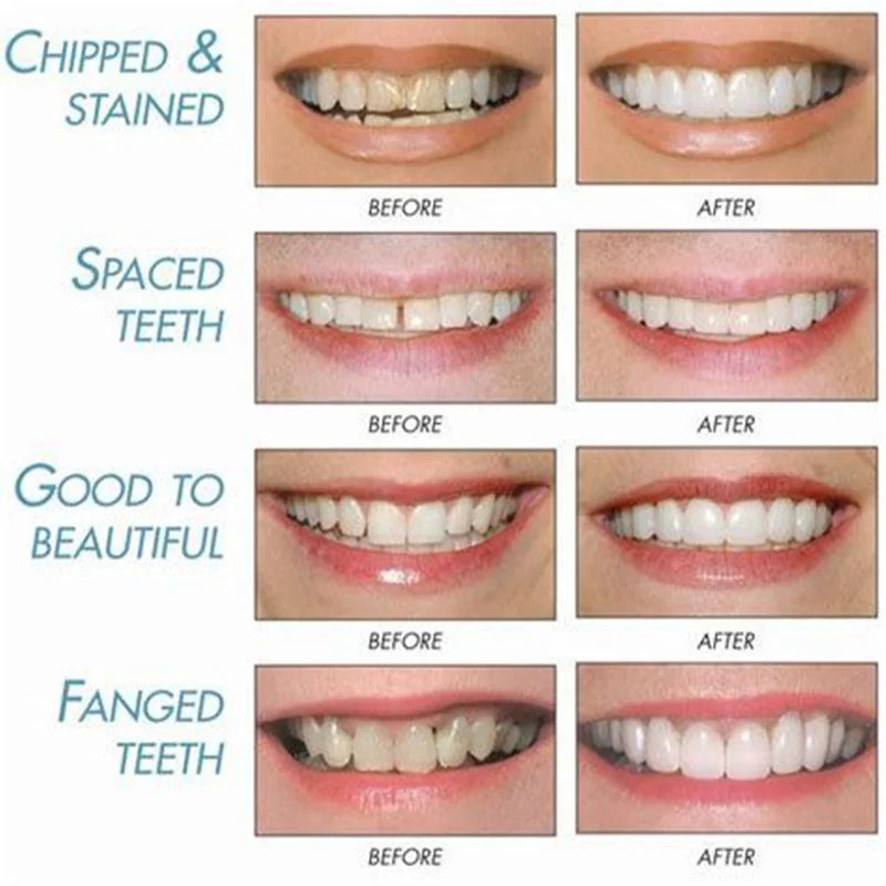 Smile Veneers Set - Premium Upper & Lower Cosmetic Dental Veneers for a Perfect Smile